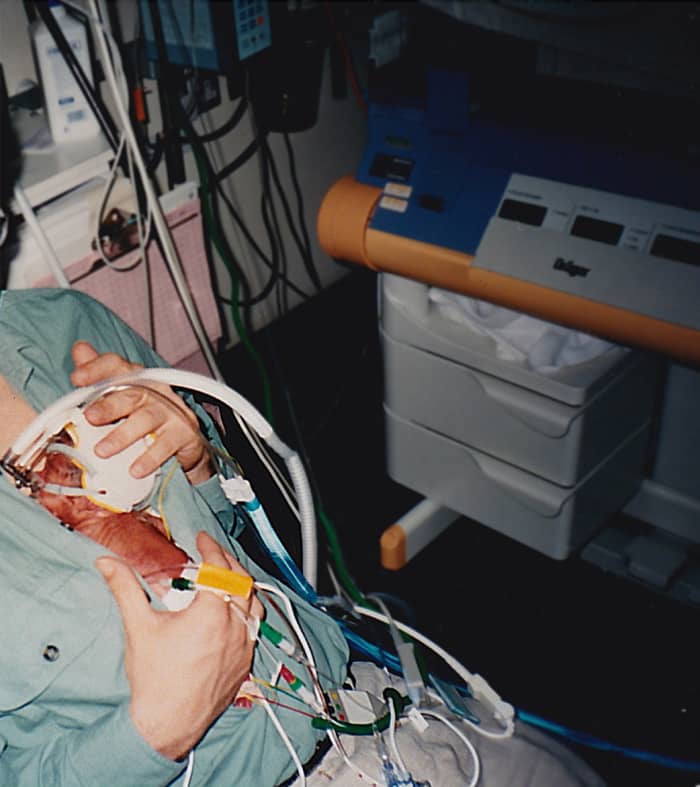 This photo shows my daughter, with IV drips, monitor wires and a CPAP tube to help her breathe, being held by my husband in Kangaroo Care.