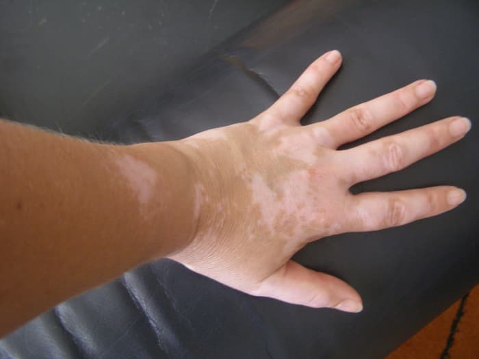 Vitiligo is a loss of melanin in the skin. Melanin helps the skin to tan. The spots of vitiligo will be random and affect hands, feet, elbows and face.
