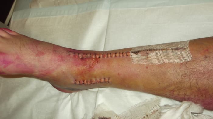 Five days after surgery on broken ankle bones including his tibia and medial malleolus, my husband had his dressings changed. Here's what his leg looks like.
