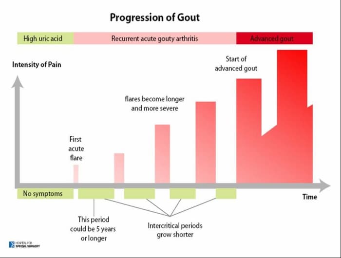 Gout and Alcohol Symptoms, Treatment and Home Remedies HubPages