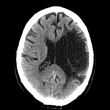 encephalomalacia prognosis