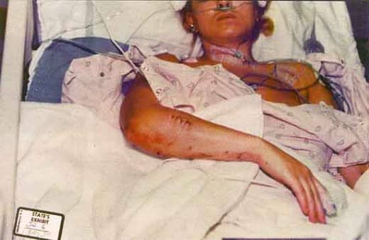 Self-inflicted? In hospital photo. Main artery barely missed in her neck. Two jurors swear they never saw these photos.
