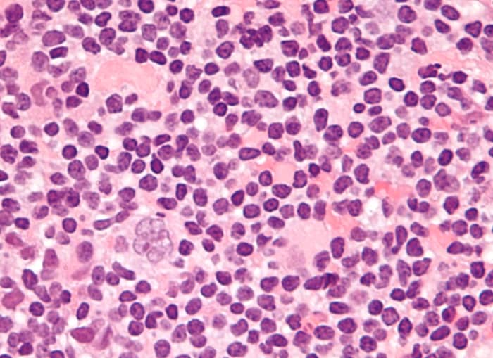 This is the type of Hodgkin's that I had when I was diagnosed the second time. Of the four types it is the most common with large tumor nodules. One of them is clearly visible slightly off center toward the bottom left.