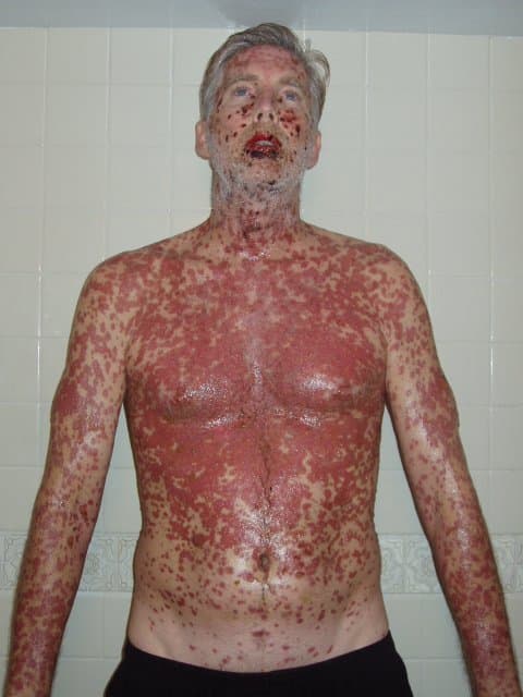 EVERYTHING hurt. Those are painful chemical burns from the inside out. 2 weeks into SJS/TENS , note: (declaration: pictures, story and name are copyright ownership by the author Dan W. Miller aka The Vanilla Godzilla.)