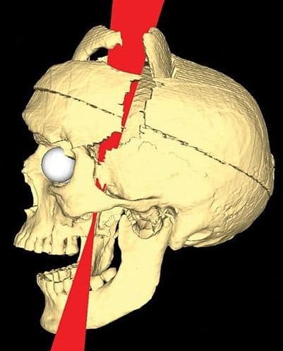The brain injury of Phineas Gage suffered in 1848 in a terrible accident. Gage recovered from his injury but he experienced dramatic psychological changes