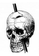 Phineas Gage Skull Diagram illustrating the trajectory of the iron bar