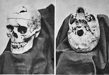 The skull of Phineas Gage