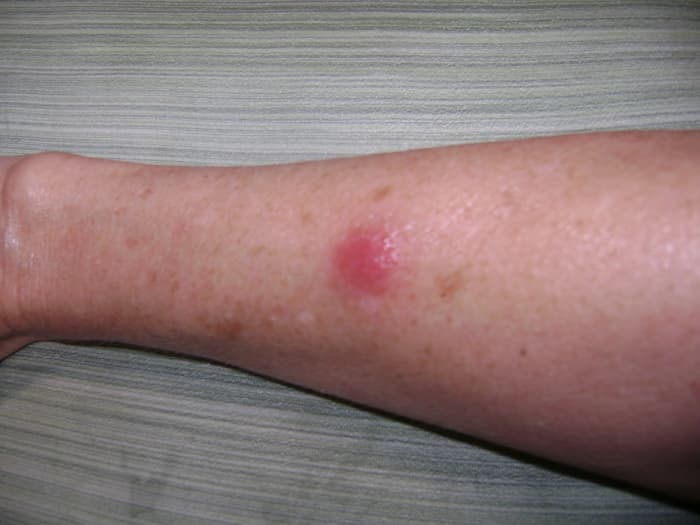 This bump started as a small mosquito bite looking thing. I noticed it the first week of June, approximately 4 weeks after exposure. NOT where the tick bit me. It is red, hard, puffy with slight fever in it.