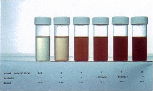 BLOOD IN URINE (HEMATURIA) - HubPages