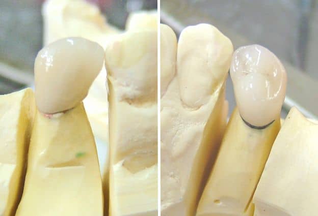 How Dental Pfm Crowns Are Made Step By Step Photos ★ Hubpages