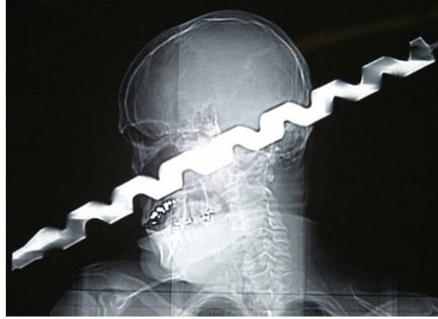 10 meest schokkende röntgenfoto's