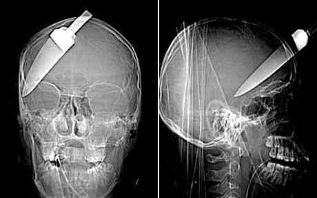 10 meest schokkende röntgenfoto's