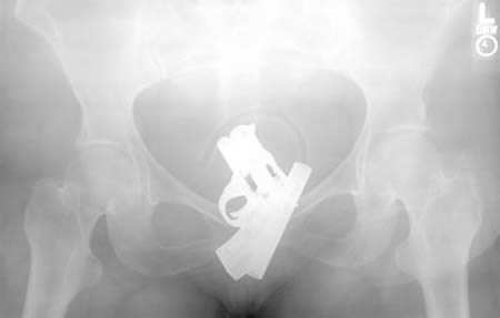 10 meest schokkende röntgenfoto's