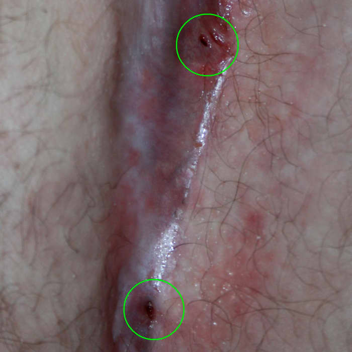 Two pilonidal cysts that have formed in the gluteal cleft of an adult male.