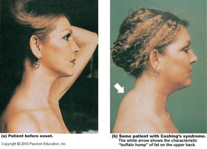 30++ Frau cushing syndrom bilder , Cushing&#039;s Syndrome; Disease Symptoms in Women HubPages