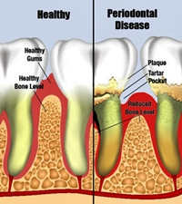 The picture on the left shows healthy teeth and gums,check for the symptoms of gum disease and visit your dentist if you spot any problems.