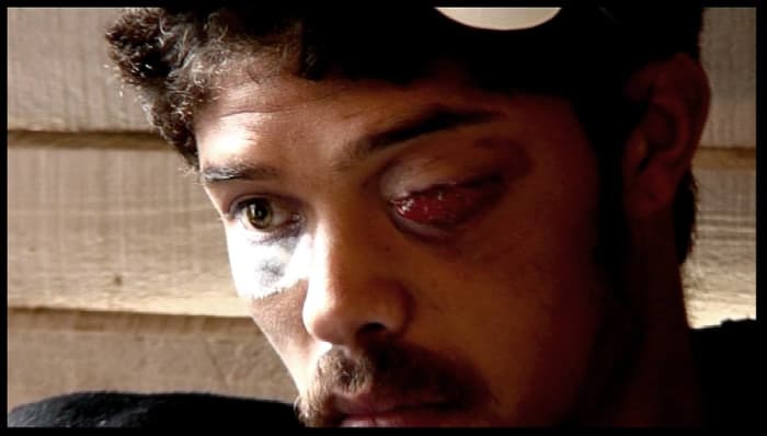 This is how Helen Zille helps the citizens of Hangberg. Delon Egypt, 22 year old resident of Hangberg, Hout Bay, had his left eye shot out by the police whilst on his way to buy bread