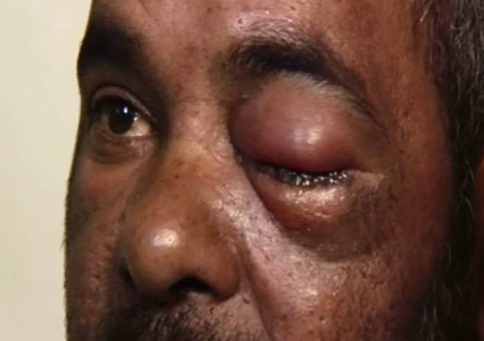 This 40-year=old fisher and his three friend found themselves at Groote Schuur hospitals blinded by a rubber bullet fired by the police. He keeps the bullet in a jar on top of his television set
