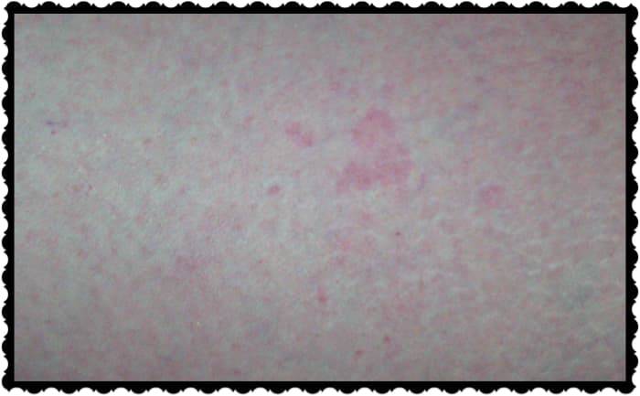It looks like one, or maybe two. There are actually 3 separate bed bug bites in this picture. They are overlapping, which makes it hard to tell.