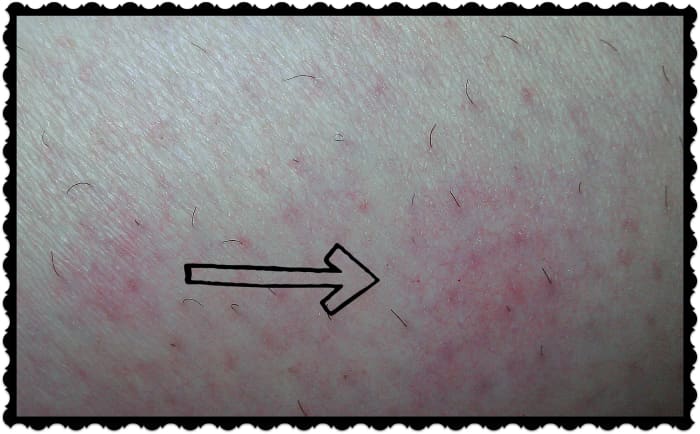 Here is a person who does not have the typical circular rash. Instead, this person reacts to bed bug bites with splotches.