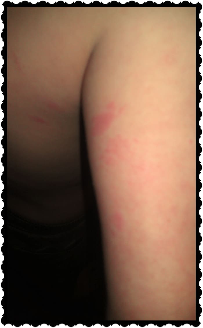 Notice the bites on the arm and torso of this 10 year old boy. These are bed bug rashes.