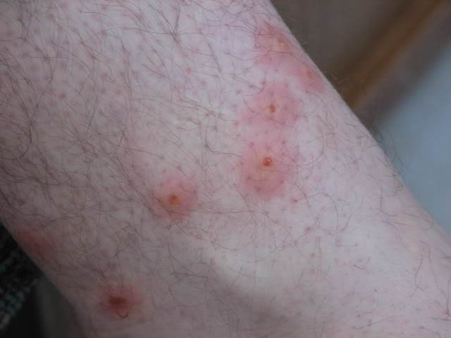 Chigger bites sometimes are more irritating than a mosquito bite because they can cause continual itching.