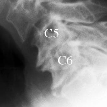 My third rheumatologist ordered X-rays like this one. He found signs of arthritis in my neck and lower back, and said otherwise my pain was from fibromyalgia.