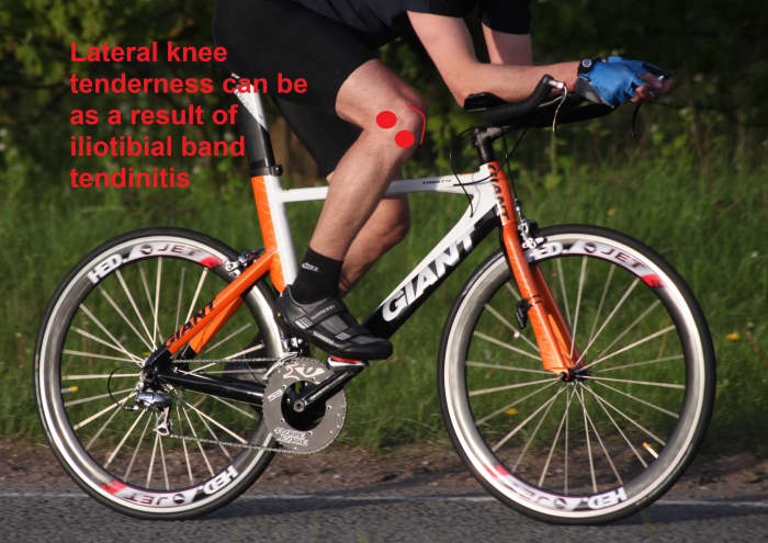 Iliotibial Band Tendinosis from cycling often features tenderness laterally above and below the kneecap (pictured)