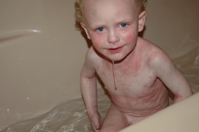 My poor baby...if we only knew the suffering he would have to endure! Kline's skin on topical steroids.