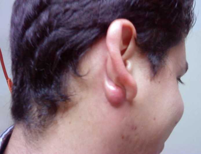 Causes, Treatments, and Pictures of Lumps Behind the Ear - HubPages