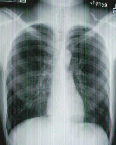 Tobacco smoke contains over 40 different carcinogens and it is associated with an increase risk of cancer in the gastrointestinal tract (Oral cavity, esophagus, stomach and pancreas).