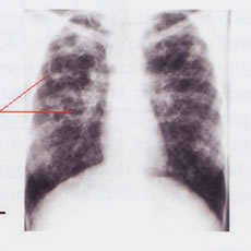 The main function of the Lungs is to provide gas exchange between inspired air (supplying oxygen) and blood in the pulmonary circle.