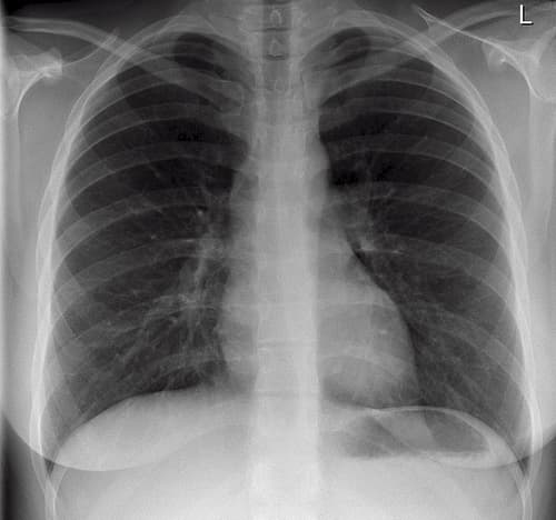 A normal chest x-ray showing all contours, the two lung parenchyma and pulmonary vessels with the bronchi branches