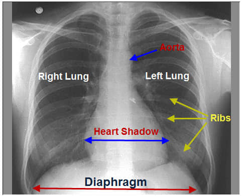 A normal chest x-ray showing all contours, the two lung parenchyma and pulmonary vessels with the bronchi branches