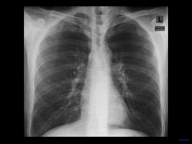 Reading The Chest X-Ray (Chest Radiography): Identifying A Normal Chest ...