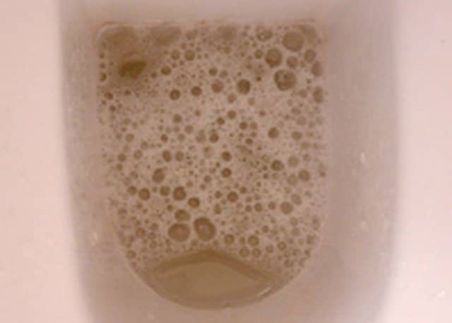 Foamy Urine Causes How Much Foam In Urine Is Normal Youmemindbody 