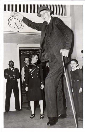 acromegaly-gigantism-the-world-s-tallest-human-hubpages