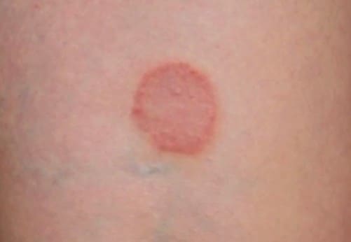 Ringworm: Images, Causes, Symptoms, Treatment - HubPages