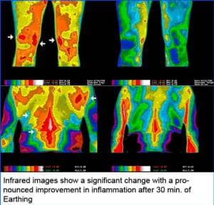 Infrared images show a significant change with a pronounced improvement of inflammation after 30 minutes of earthing.