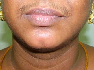 Using razor can increase the hair growth as well their strengthen its texture. Check this row of upperlips hair which is dense, thick and notably black.
