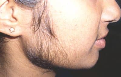 Excessive hair on face.The hair is hormonal because it's been grown in a massive amount on the sideburns.