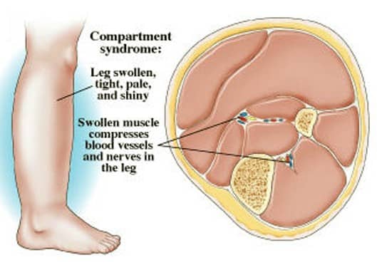 Compartment Syndrome Pictures Treatment Causes Surgery Hubpages