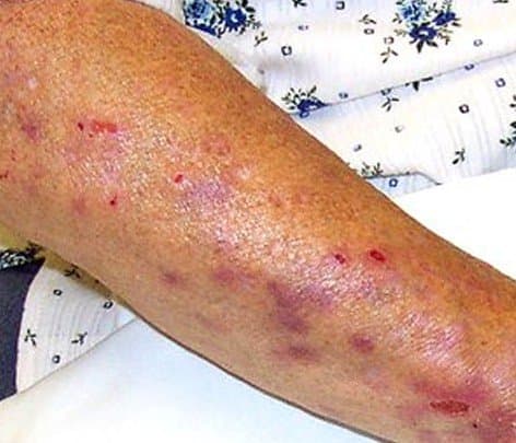 Calciphylaxis - Pictures, Symptoms, Diagnosis, Treatment, Causes - HubPages