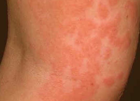 Contact Dermatitis - Pictures, Symptoms, Causes, Treatment - Hubpages