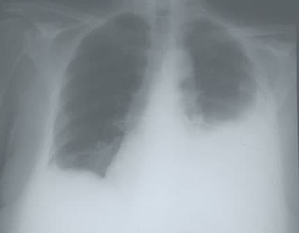 Pleurisy (also known as pleuritis) is an inflammation of the pleura, the lining surrounding the lungs. There are many possible causes of pleurisy but viral infections spreading from the lungs to pleural cavity are the most common.