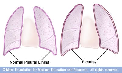 Thoracentesis usually does not cause serious complications. Generally, a chest x-ray is done after the procedure to evaluate the lungs.