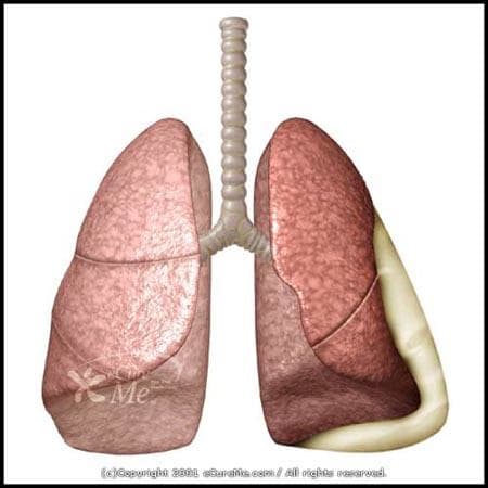A chest x-ray takes a picture of the heart and lungs. It may show air or fluid in the pleural space. It also may show the cause (e.g. pneumonia, a fractured rib, or a lung tumor) of the pleurisy.