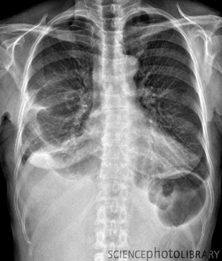 The procedure to remove fluid in the chest is called a diagnostic thoracentesis. The doctor inserts a small needle or a thin, hollow, plastic tube in the chest wall and withdraws fluid.