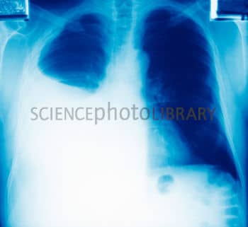The goals are to rule out other sources of the symptoms and to find the cause of the pleurisy so that the underlying disorder can be treated.