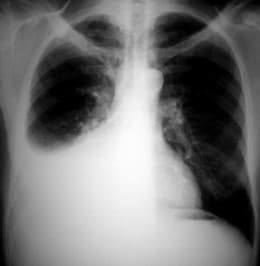The defining symptom of pleurisy is a sudden sharp, stabbing, burning or dull pain in the right or left side of the chest during breathing, especially when one inhales and exhales
